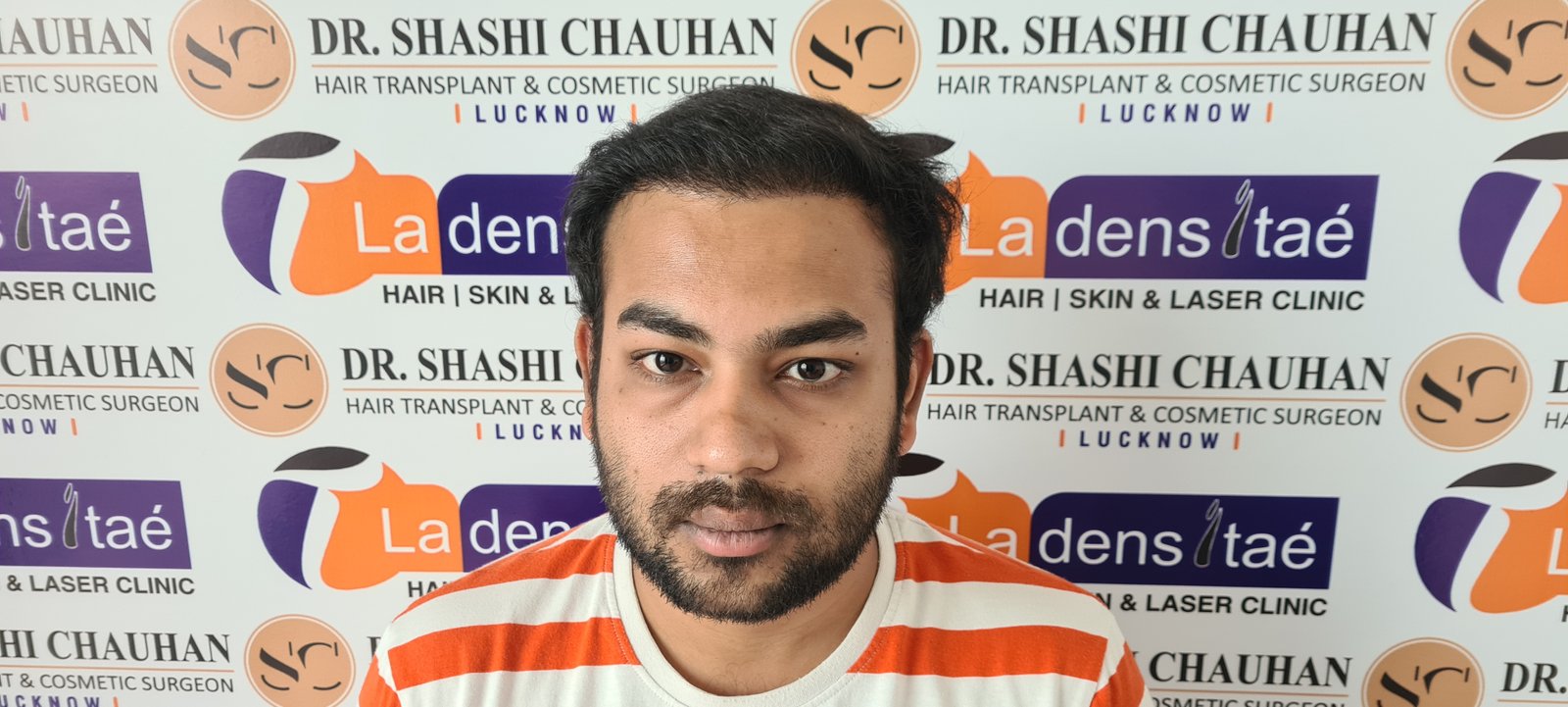 Arnav Dayal After Hair Transplant